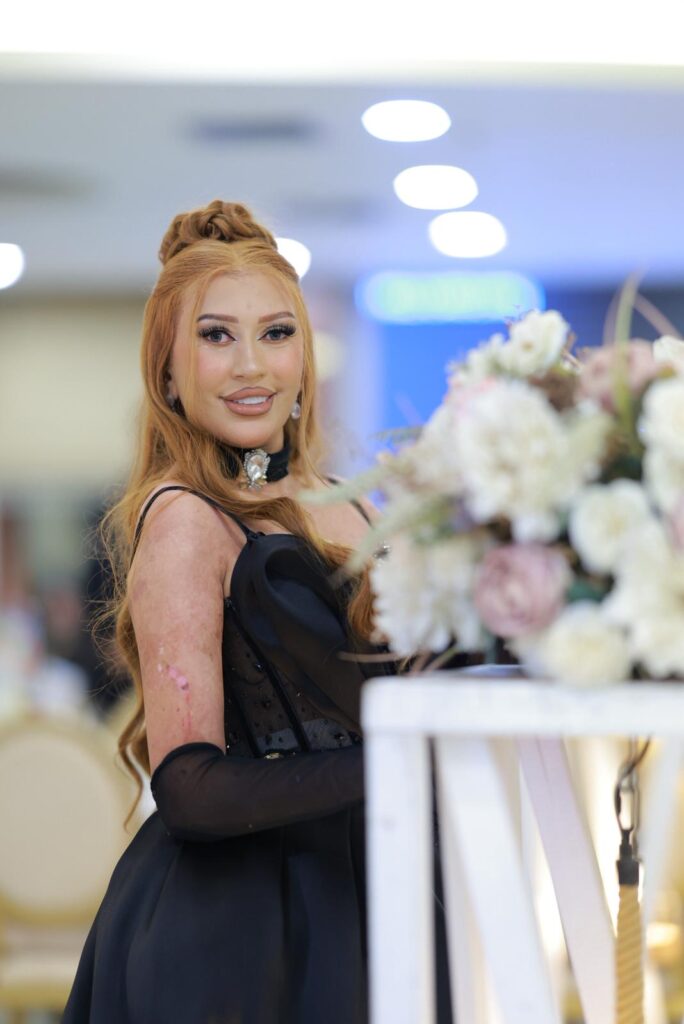 شيماء ججيني: "مرض الجلد الفقاعي لم يوقفني.. وصالوني هو رسالتي للناس" 8 f5de046a b5d6 4317 bb30 0c14923a388e