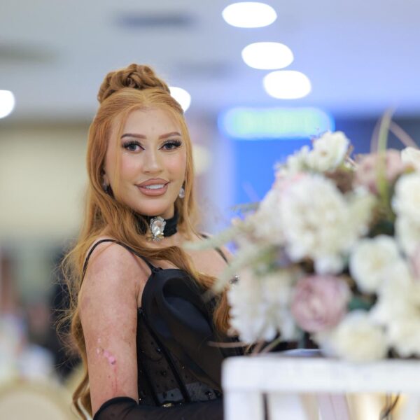 “مرض الجلد الفقاعي لم يوقفني.. وصالوني هو رسالتي للناس”