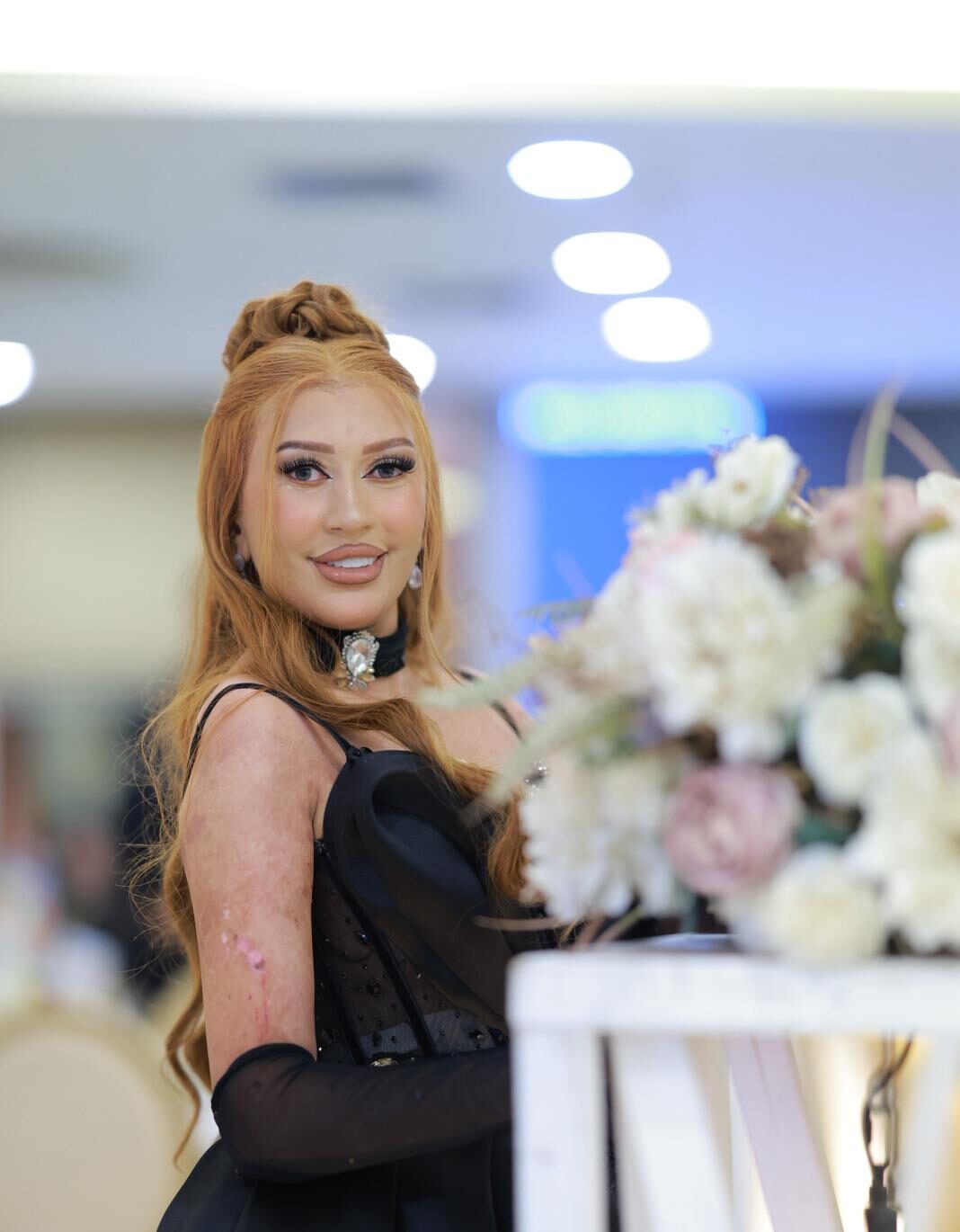 "مرض الجلد الفقاعي لم يوقفني.. وصالوني هو رسالتي للناس"