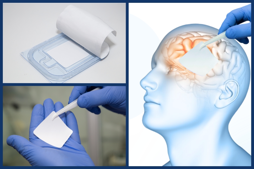 "بلاستر نانويّ": هكذا ابتكرت نورا علاجاً ثورياً لأخطر مضاعفات جراحة الدماغ يصل إلى غرف العمليات عالمياً 8 nurami